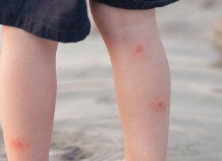 Cách xử lý khi bị côn trùng cắn hoặc đốt